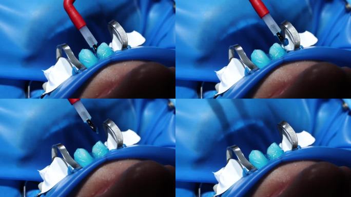 牙医将保护性的光聚合物凝胶涂在牙龈表面和牙齿之间