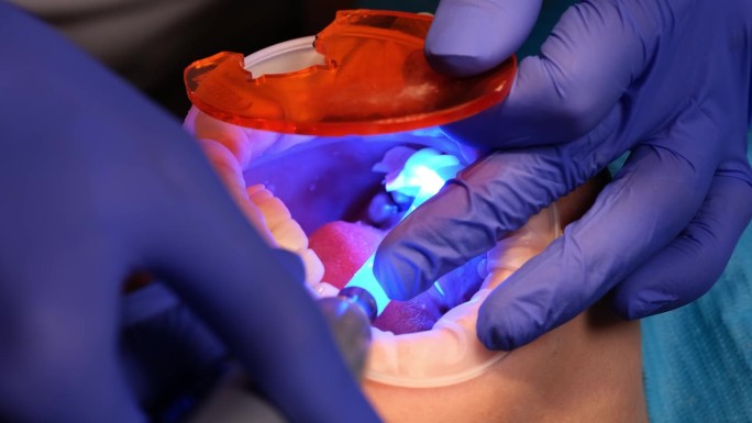 牙医用紫外线灯烘干牙齿内的光聚合物填充物