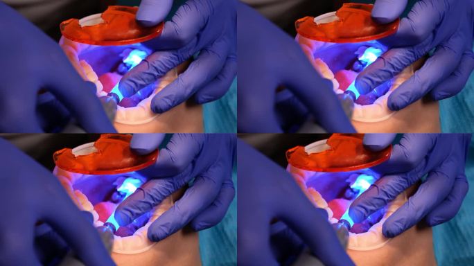 牙医用紫外线灯烘干牙齿内的光聚合物填充物