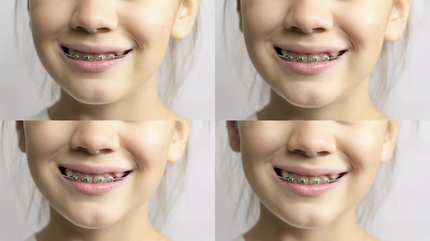 戴着牙套的小女孩的微笑。特写镜头。