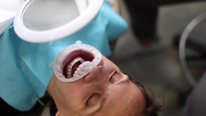 妇女在诊所检查牙贴面
