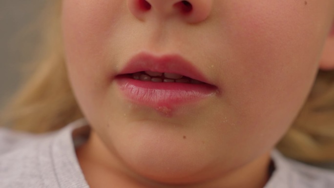 一个漂亮小女孩嘴唇上的疱疹病毒
