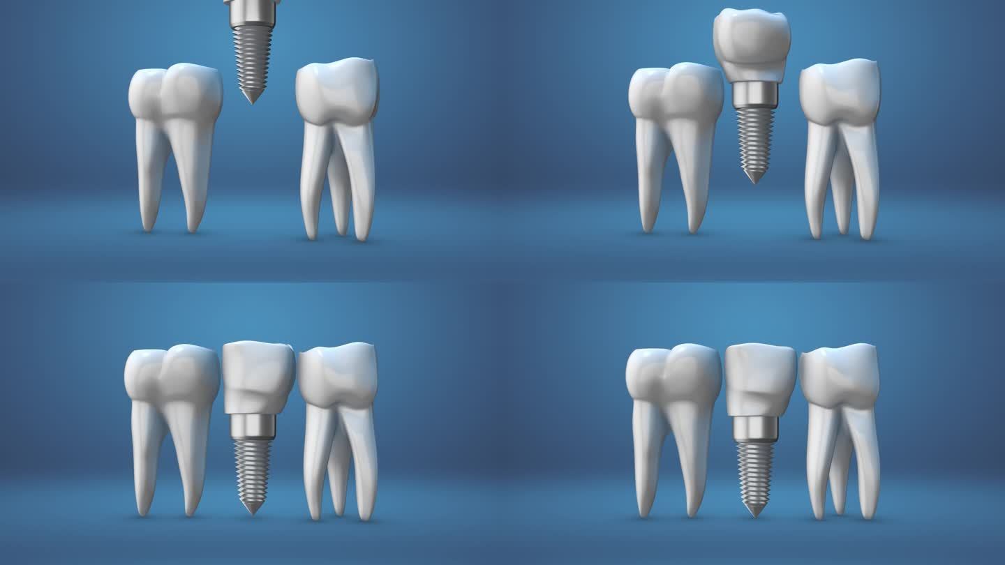植牙动画种植牙牙疼补牙