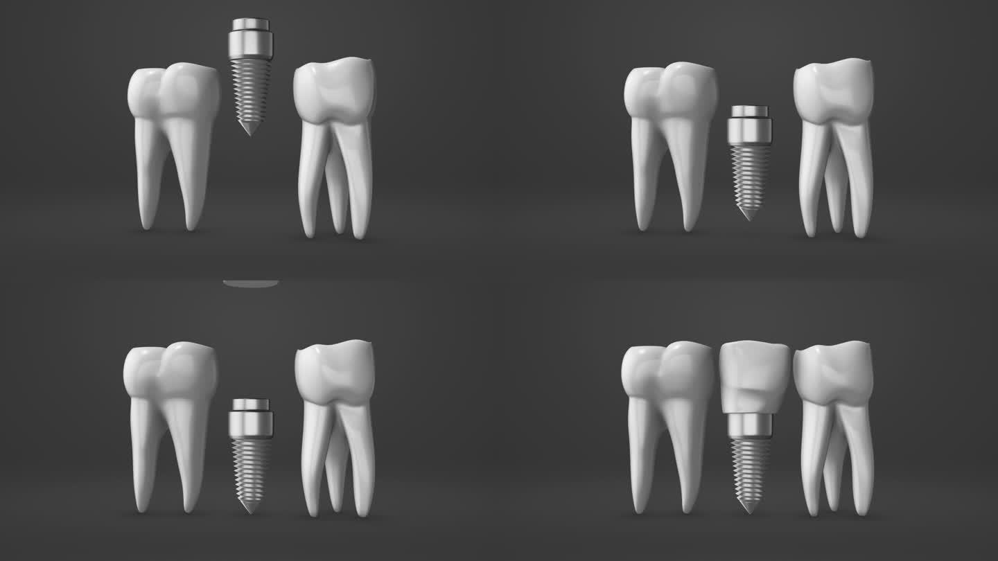 种植牙和冠安装过程