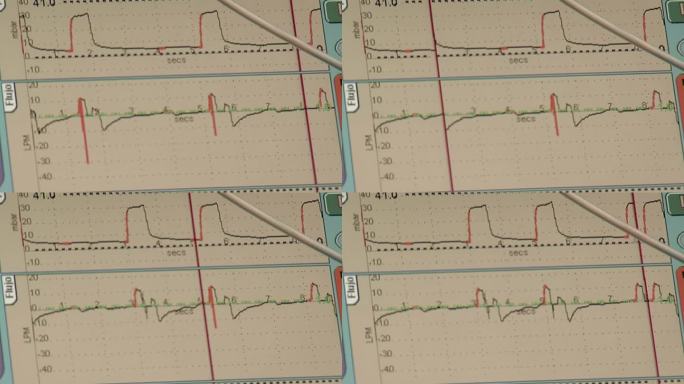 新生儿重症监护病房呼吸机生命体征及呼吸监测特写镜头。
