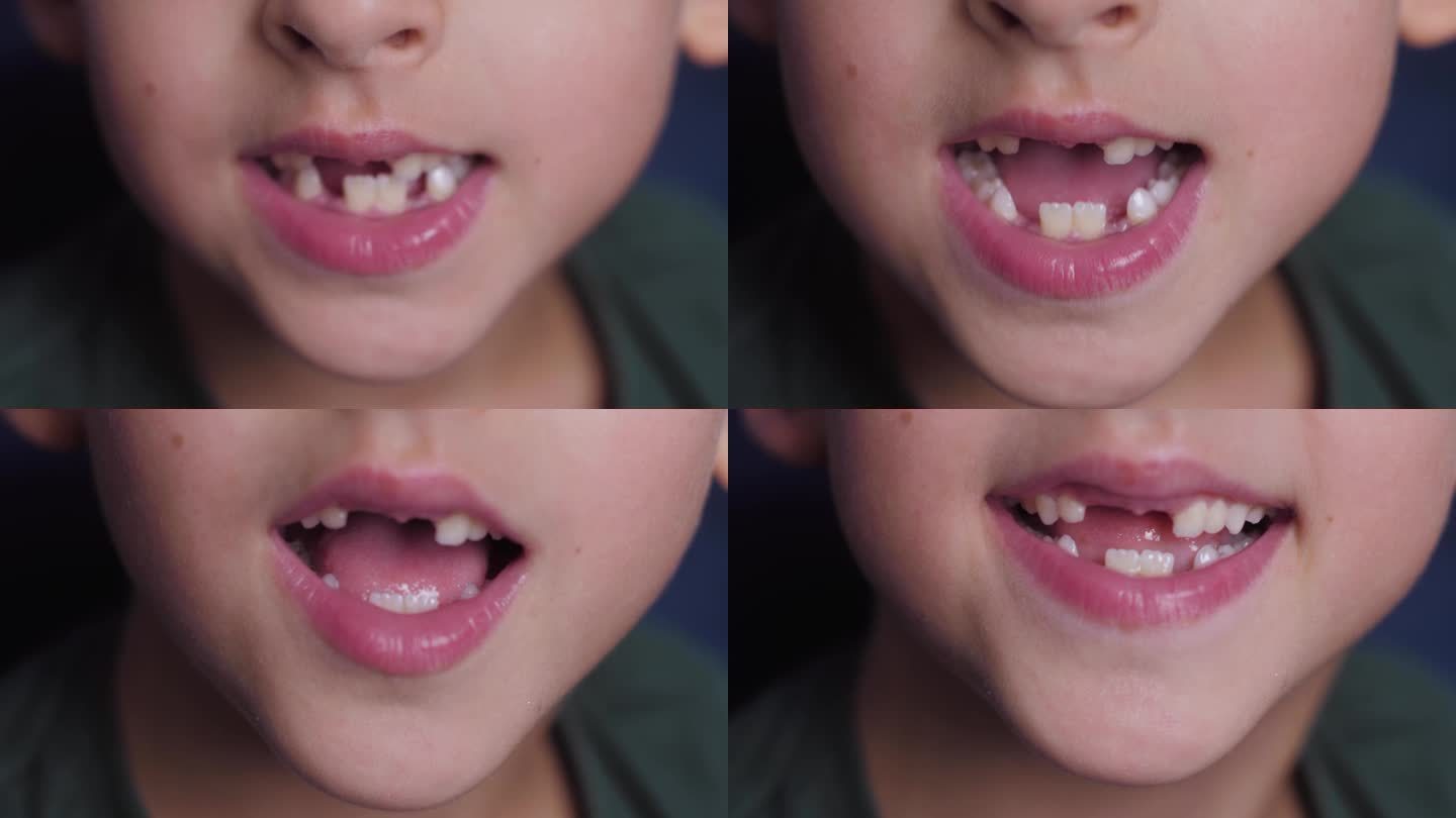 近口小孩掉了一颗乳牙。更换恒换牙、无牙微笑、牙龈破洞。儿童牙科概念。小男孩穿着一件绿色t恤，对着镜头