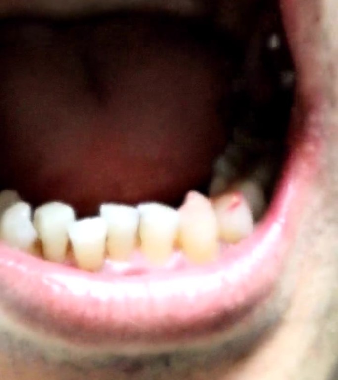 龋齿治疗后的牙齿视频