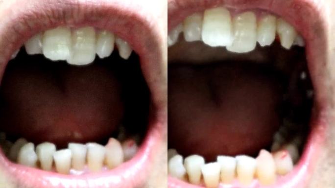 龋齿治疗后的牙齿视频