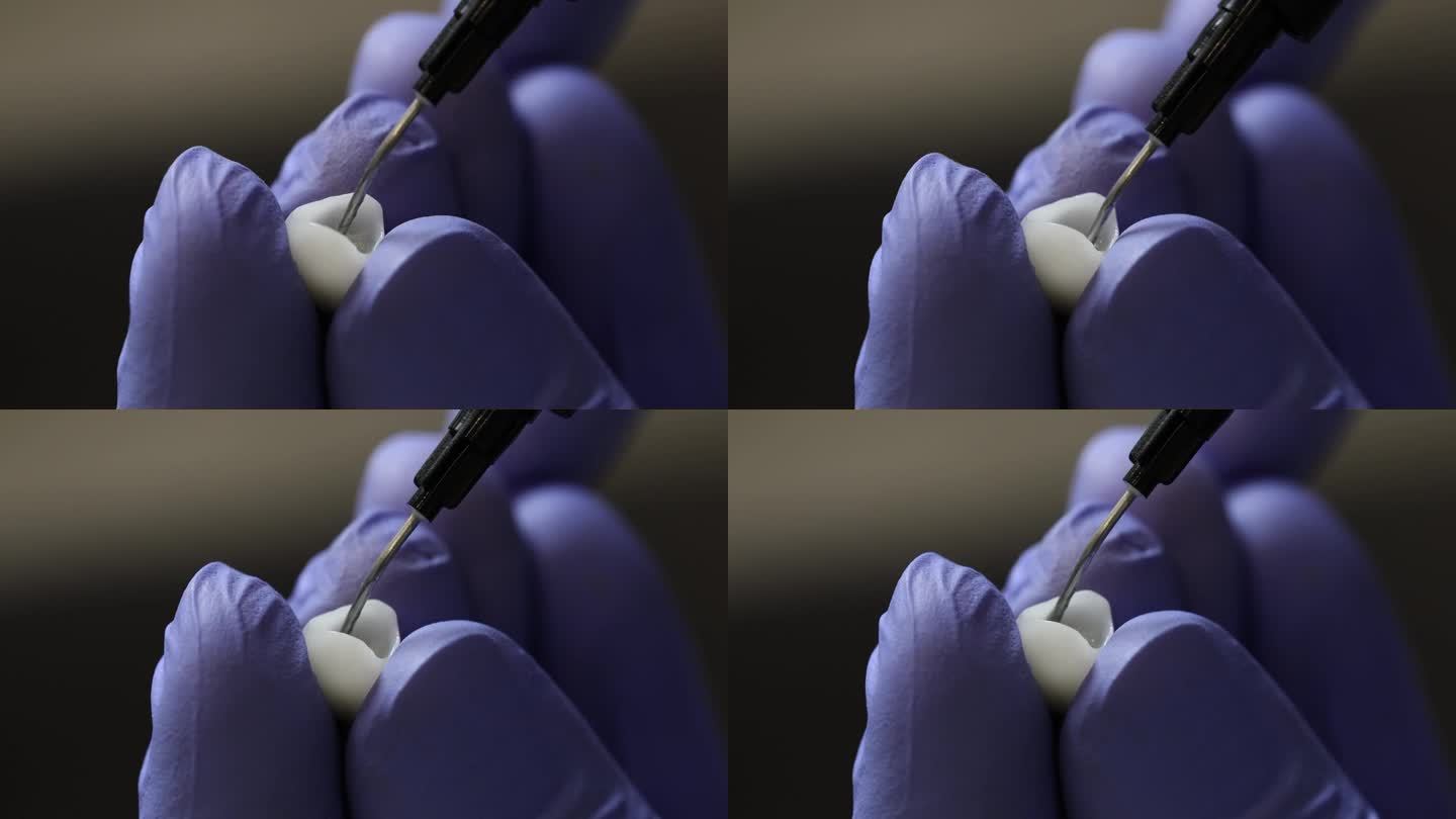 骨科牙医在牙冠上涂胶固定近距离4k电影