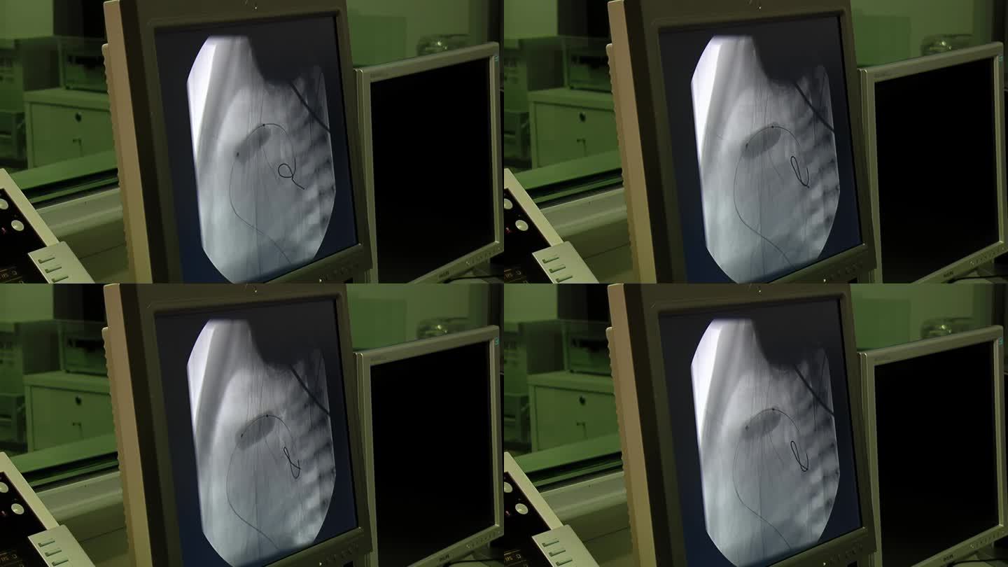 手术中病人在监护仪上的胸部X光片。关闭了。