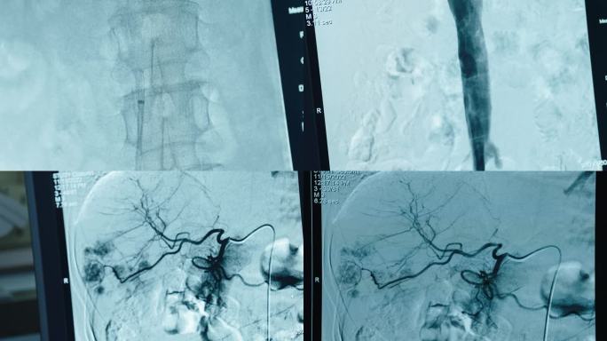 介入科血管造影影像2