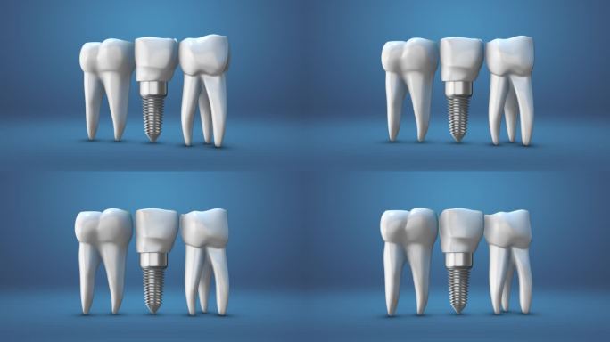人类牙齿和假牙的动画