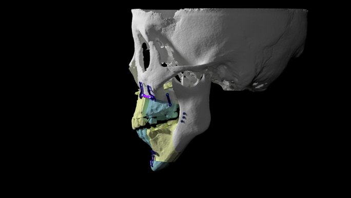 可定制的3D演示的双颚凸嘴正畸手术