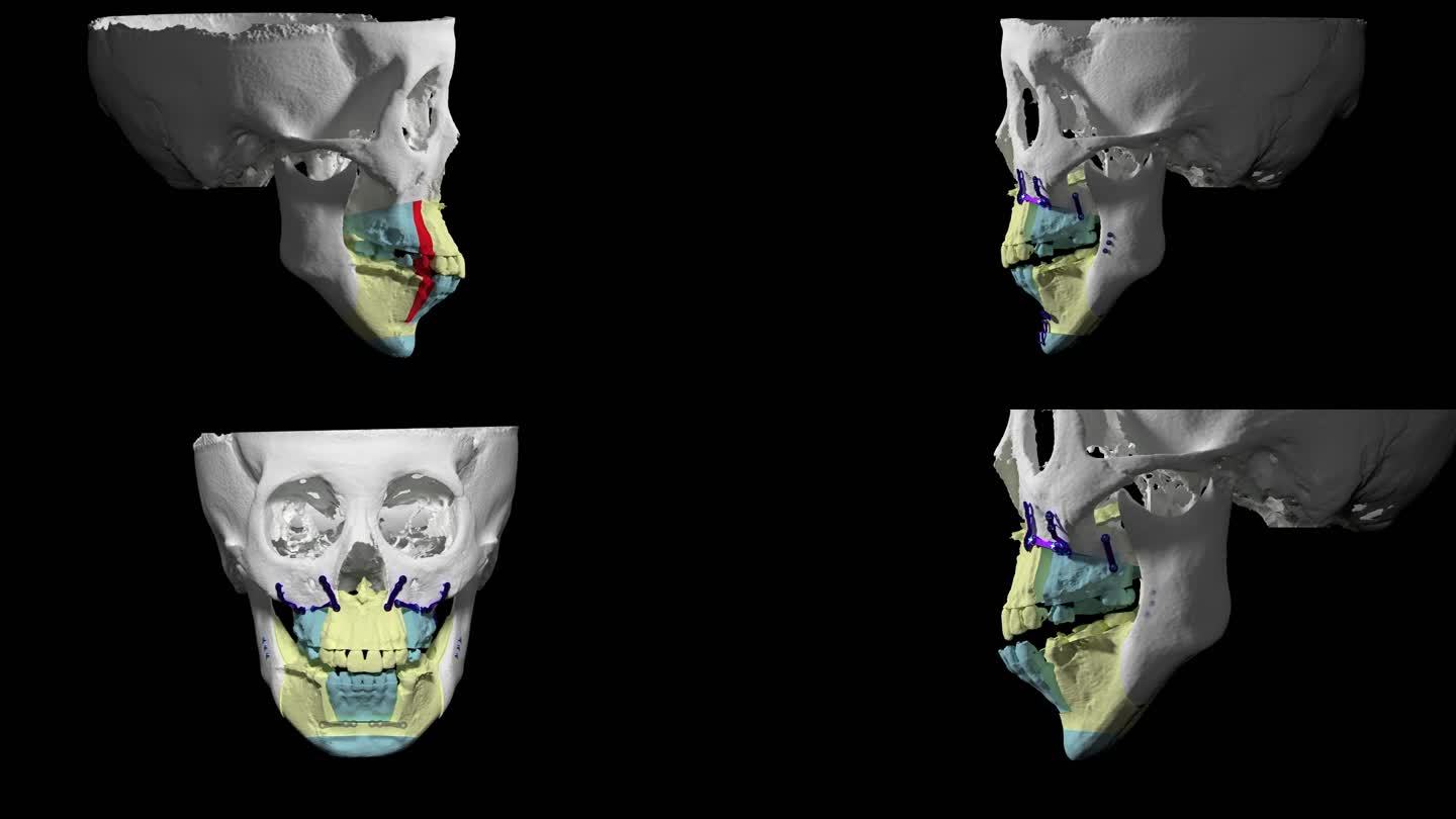 可定制的3D演示的双颚凸嘴正畸手术