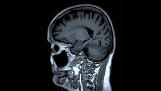 大脑矢状图可以帮助医生寻找出血、肿胀、肿瘤、感染、炎症、损伤或中风等疾病。