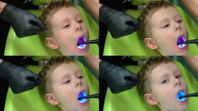 牙医正畸手术用蓝色美白灯，固化牙齿，护理牙齿的理念