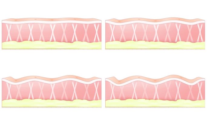 胶原纤维支撑着皮肤，胶原纤维的减少导致皱纹的形成