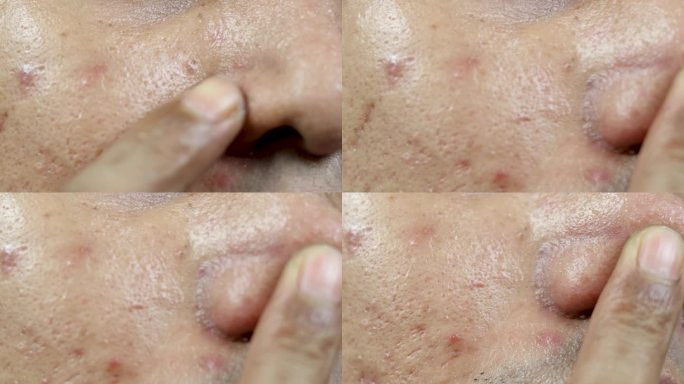 皮肤问题。脸上发炎痘痘的问题。炎症性痤疮包括肿胀、发红、毛孔被细菌、油脂和死皮细胞严重堵塞。
