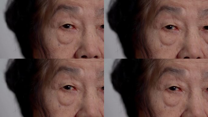 眼科检查时老年性白内障的近照。黑眼圈、成熟白内障、核硬化性白内障可见白色浑浊盘。接近半面视图