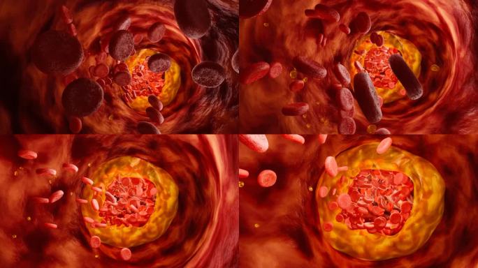 高脂血症。动脉阻塞的概念和人体血管作为一种疾病与胆固醇脂肪堆积堵塞。动脉阻塞，动脉中的胆固醇斑块。三