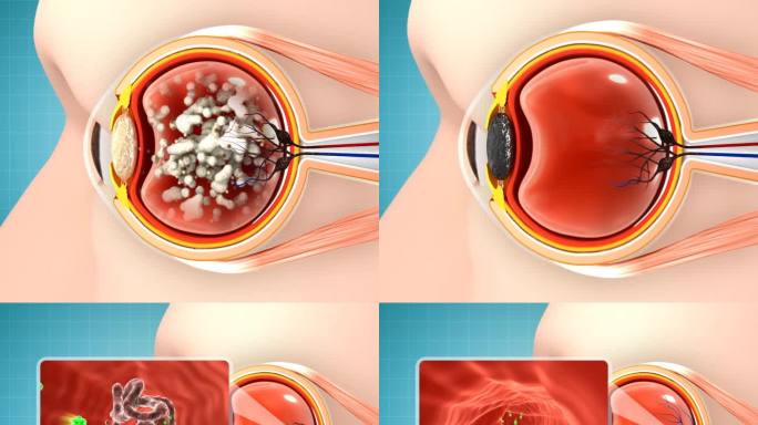 治疗眼病白内障疏通血管