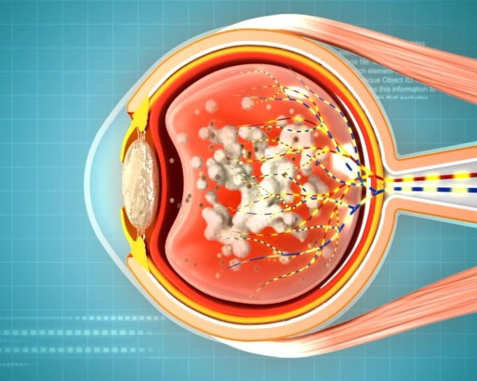 白内障眼底病变眼病