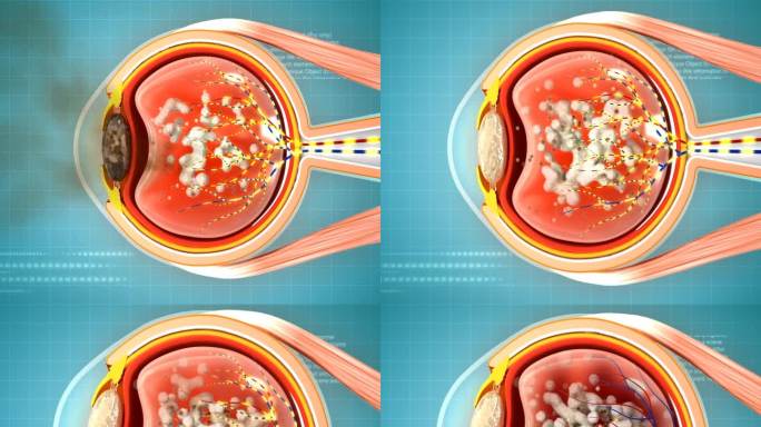 白内障眼底病变眼病