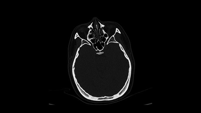 动态头部CT影像 头骨CT影像