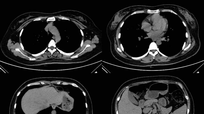 动态肺部CT影像 胸部CT影像 腹部CT