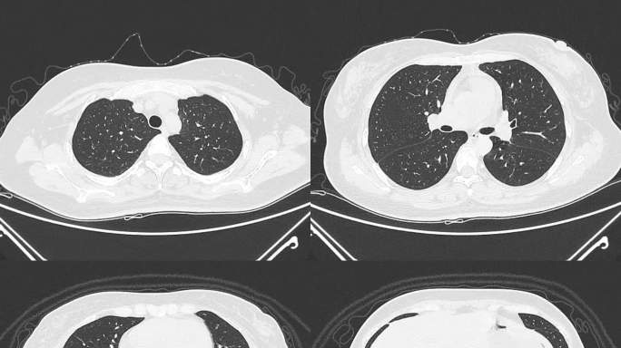 动态胸部CT影像 肺部CT影像 腹部CT