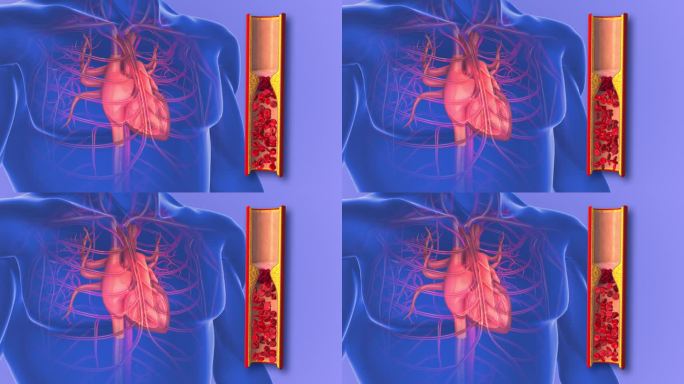 心脏动脉粥样硬化或动脉阻塞