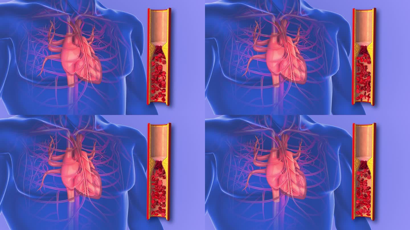 心脏动脉粥样硬化或动脉阻塞