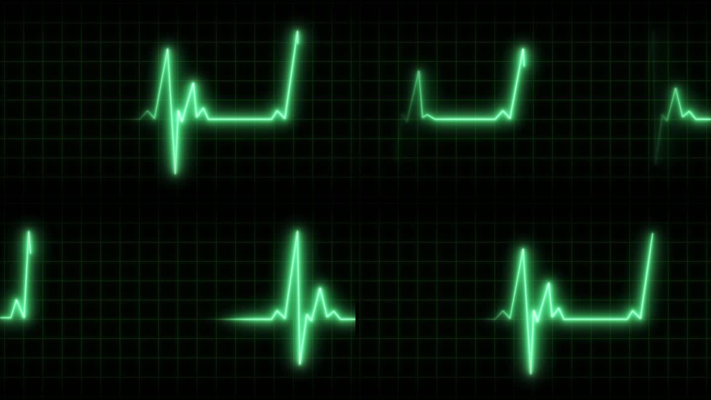 心电图监护仪运动中的心跳线