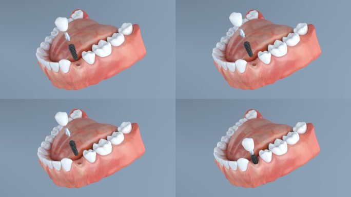 种牙 种植牙 牙齿矫正 牙齿健康