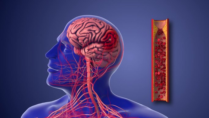 缺血性中风或由动脉粥样硬化性狭窄引起的脑血管疾病
