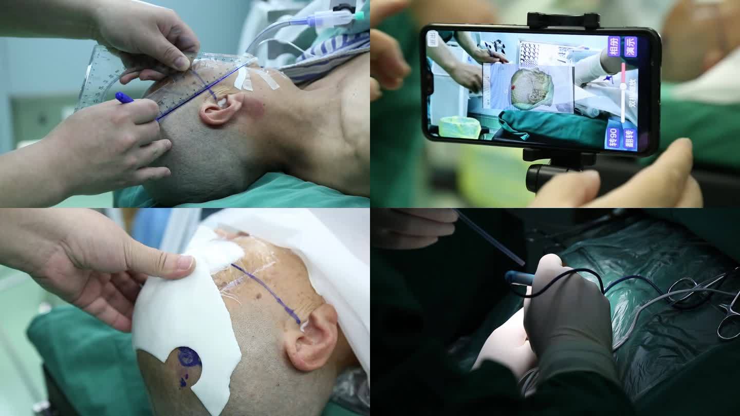 医院神经外科显微镜3D手术镜头