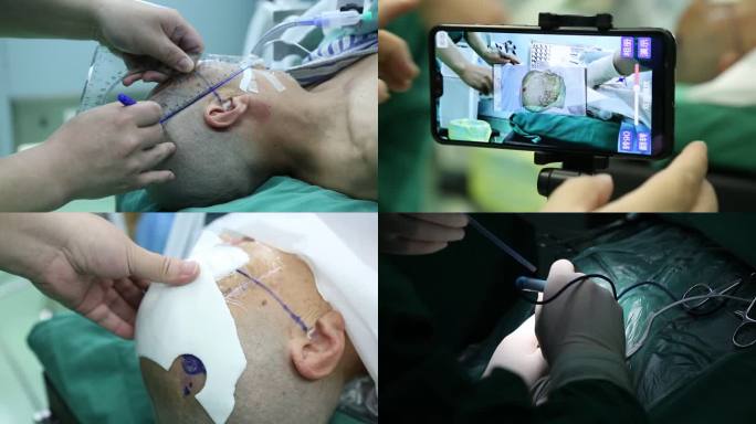 医院神经外科显微镜3D手术镜头
