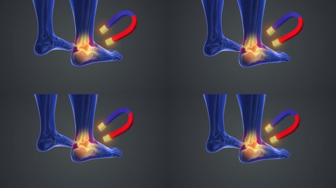 磁疗治疗足部关节疼痛