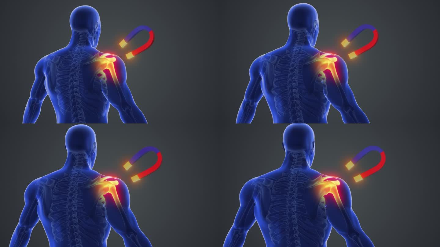 肩关节疼痛的磁疗人体骨骼科技人体三维动画