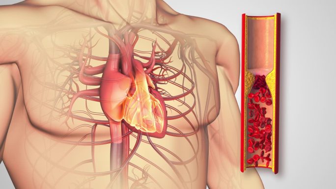 动脉粥样硬化疾病或动脉阻塞的心脏疾病