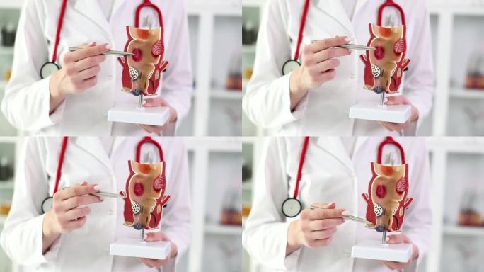 医学教授在人体器官的人造模型上展示直肠疾病特写4k电影慢动作