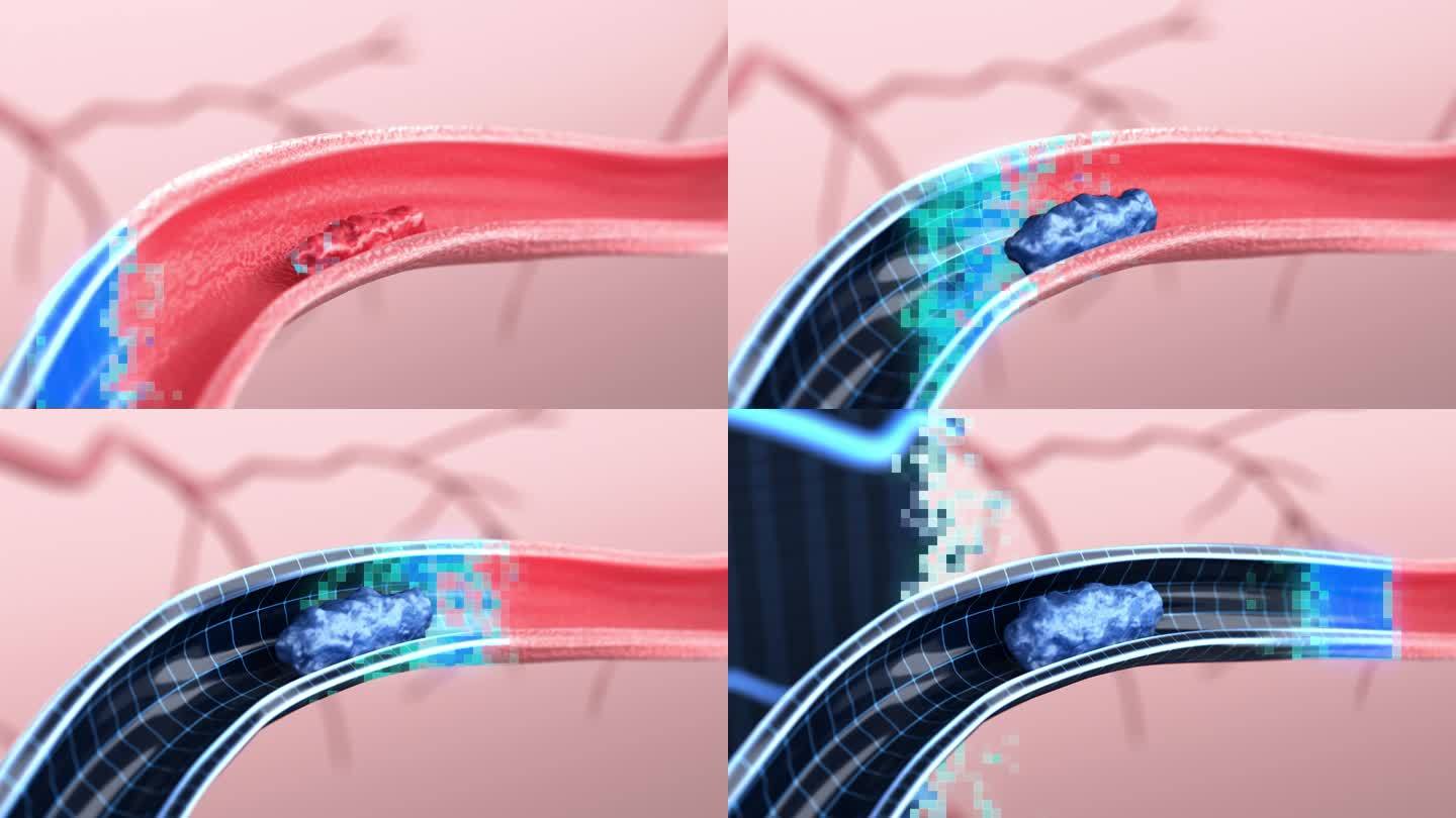 科技血管堵塞血栓形成