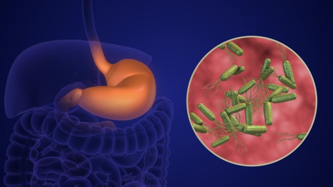 幽门螺杆菌引起的胃部感染