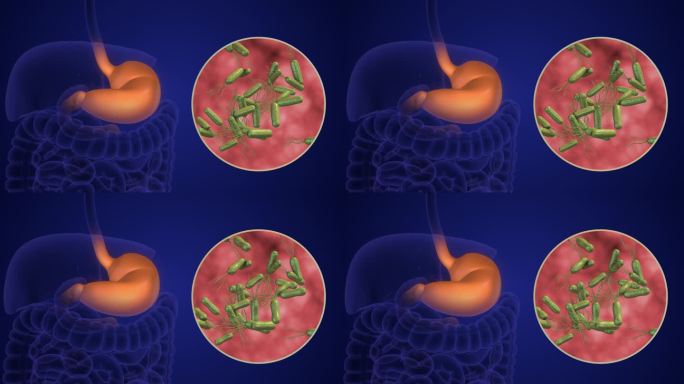 幽门螺杆菌引起的胃部感染