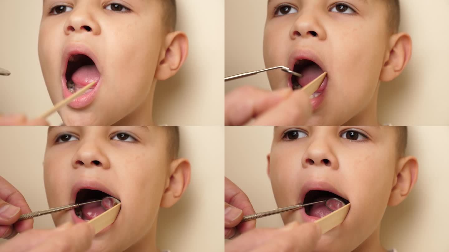 医生用牙镜和木铲检查缺牙儿童的口腔。医疗保健和牙科保健概念。