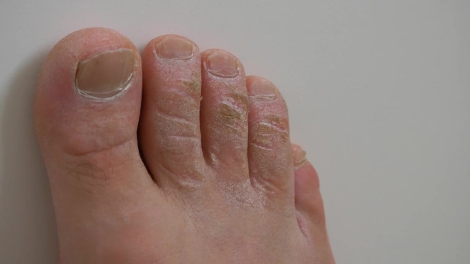 脚趾上的死皮，患真菌病的近距离脚趾，