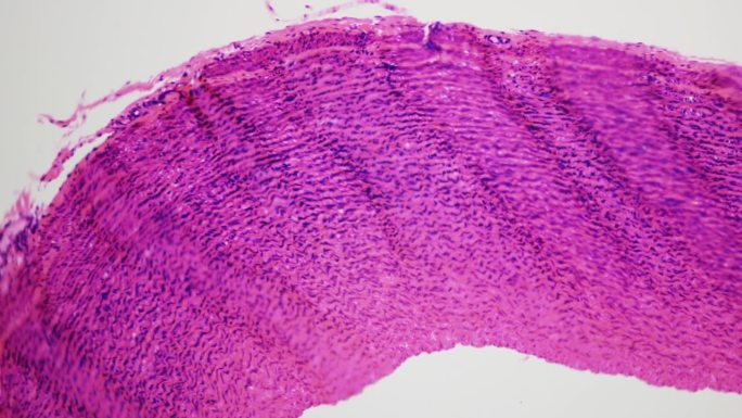 人动脉标本。显微镜下的HQ视频，放大400倍。人类最常见的死亡原因。人的心血管系统。血栓和胆固醇斑块