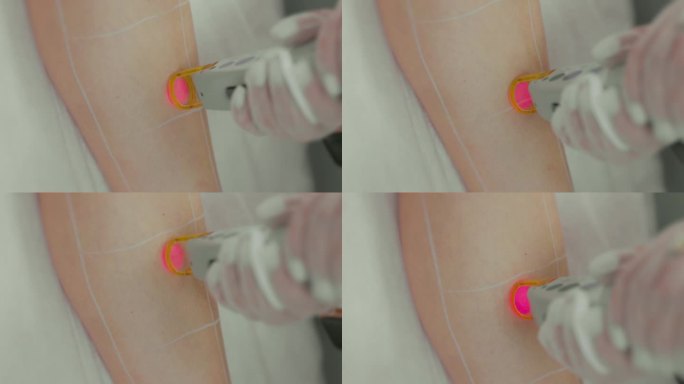 一位女性客户的腿接受激光脉冲破坏毛囊的特写镜头。美容院的激光脱毛手术。缓慢的运动。