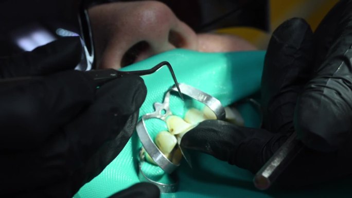 牙科极端近距离微距视频。牙医治疗病人的牙齿。正畸医生与助手使用围堰工作。专业口腔卫生理念。4k 12