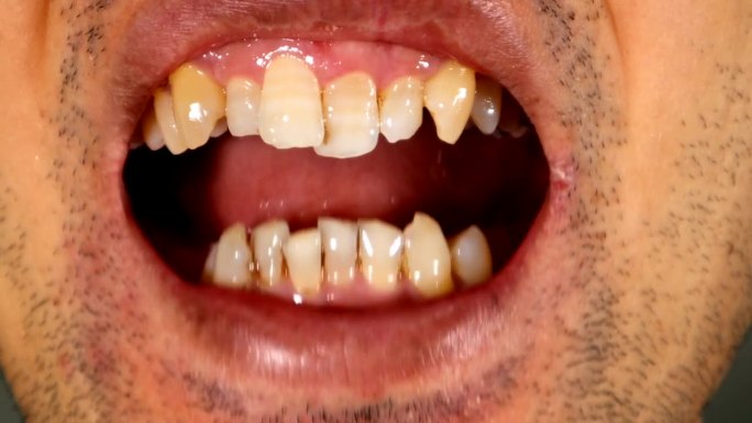 一名牙齿歪斜的日本男子的视频